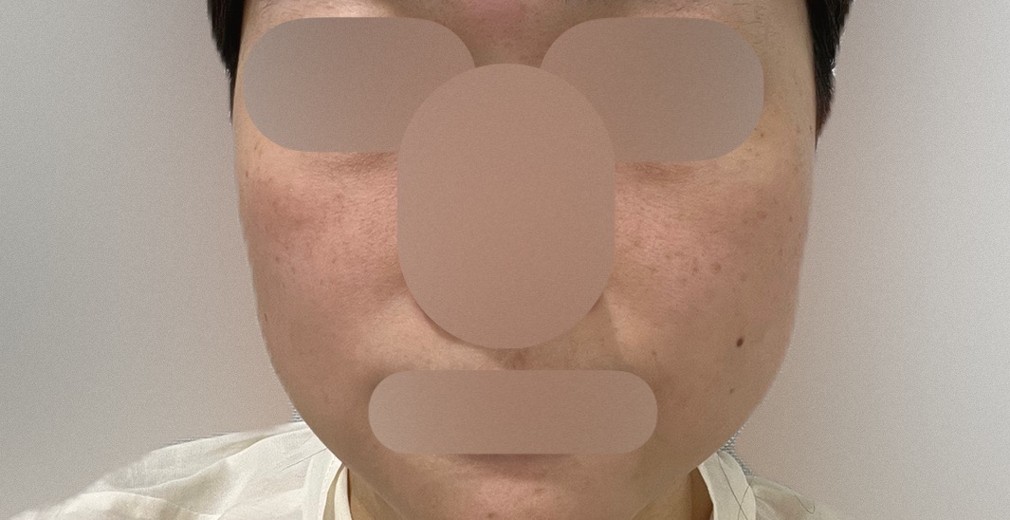 after photo: ハイドラフェイシャル