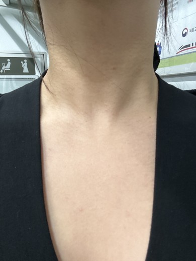 after photo: 침샘보톡스