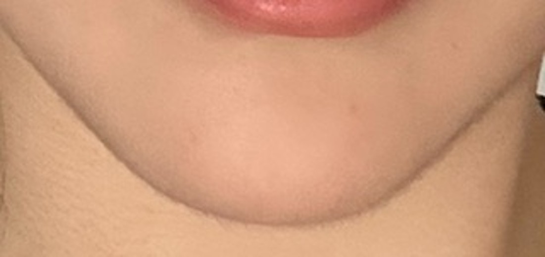 before photo: 윤곽주사