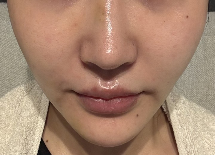 after photo: ジュベルック(Juvelook)