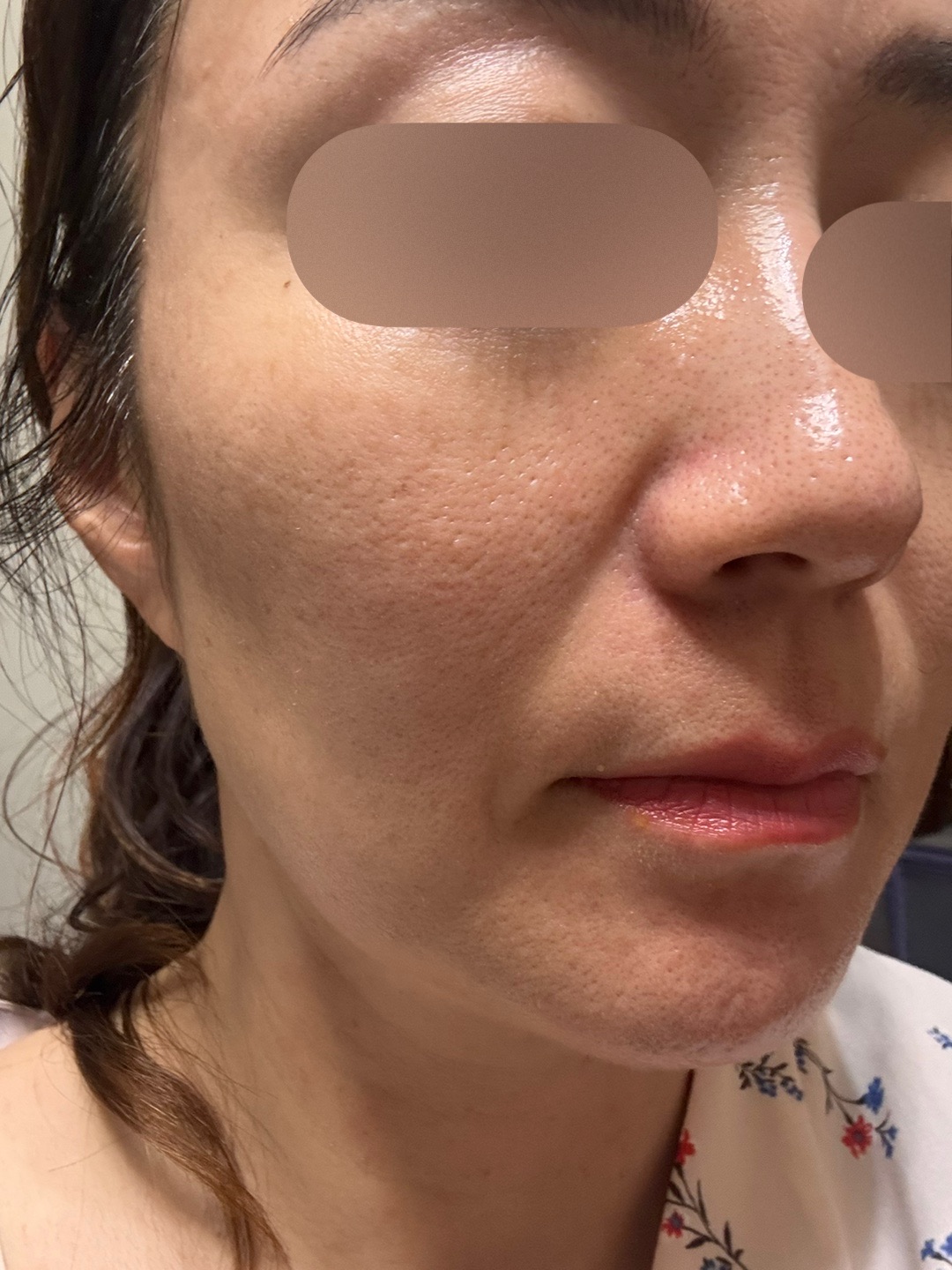 ハイドラフェイシャル＋ケアシス｜トラネキサム酸導入｜全顔 | こまち