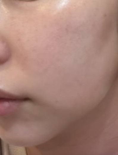 after photo: サーモン注射