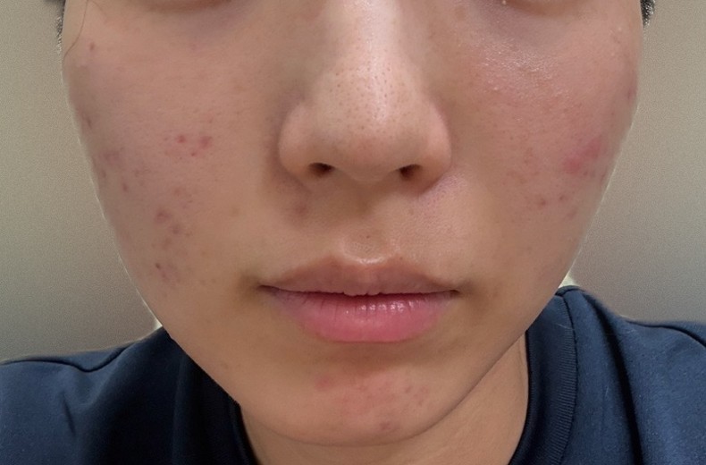 after photo: IPL(光/フォト治療), ピーリング, エレクトロポレーション, ルメッカ