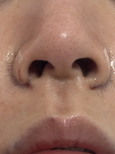 after photo: 콧볼축소