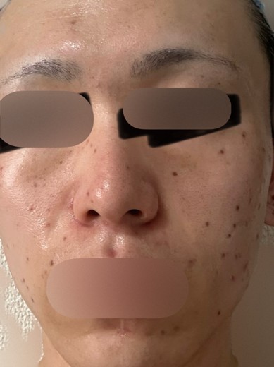 before photo: ピコスポット