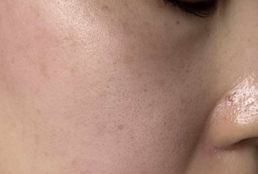 エレクトロポレーション【再来OK】 | ライズワン美容皮膚科クリニック