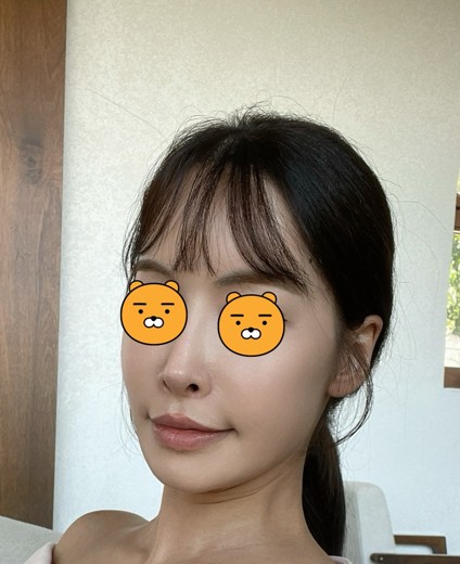 after photo: 스킨보톡스