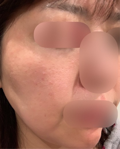 after photo: エレクトロポレーション, ハイフ(HIFU)