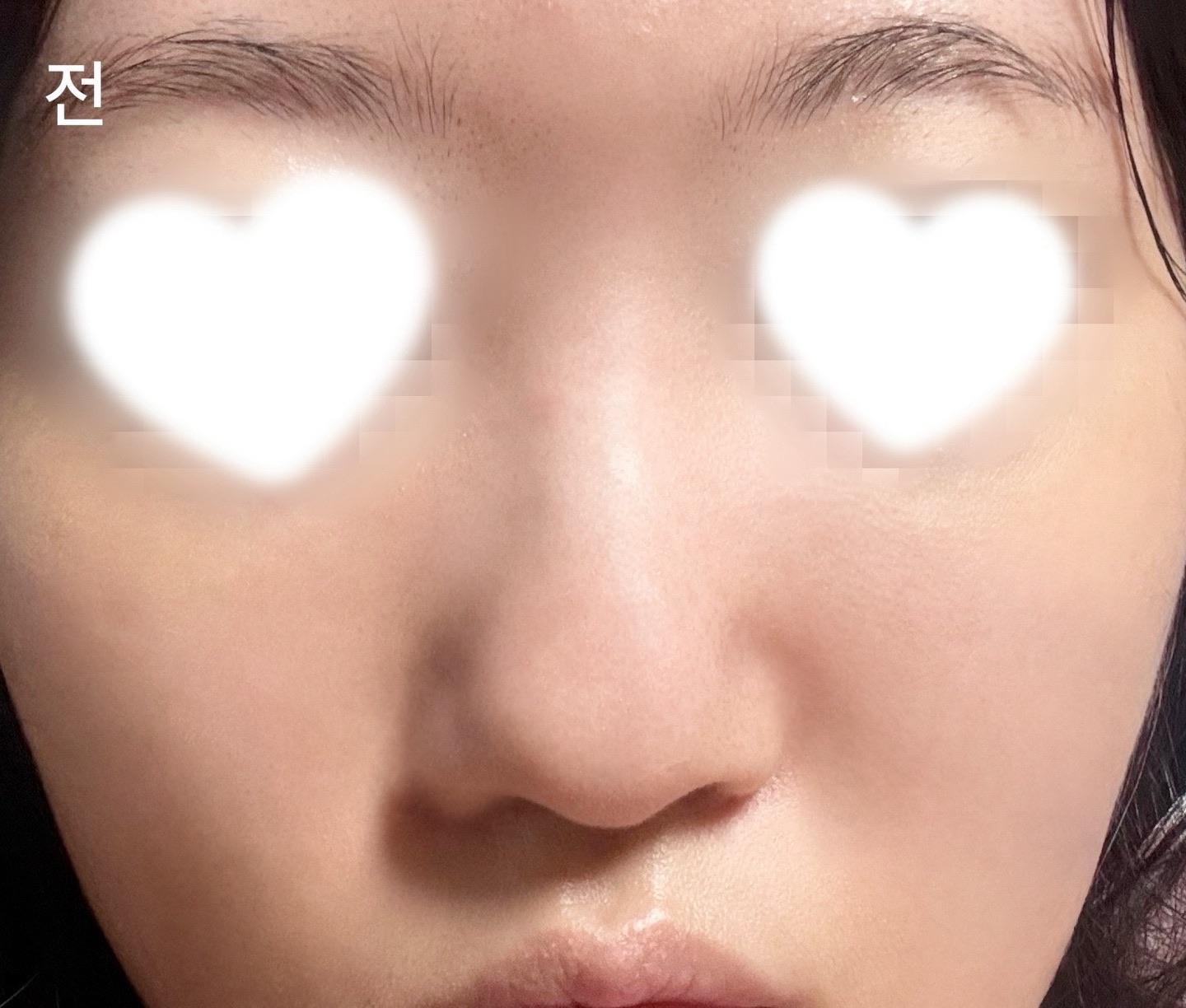 시술 후