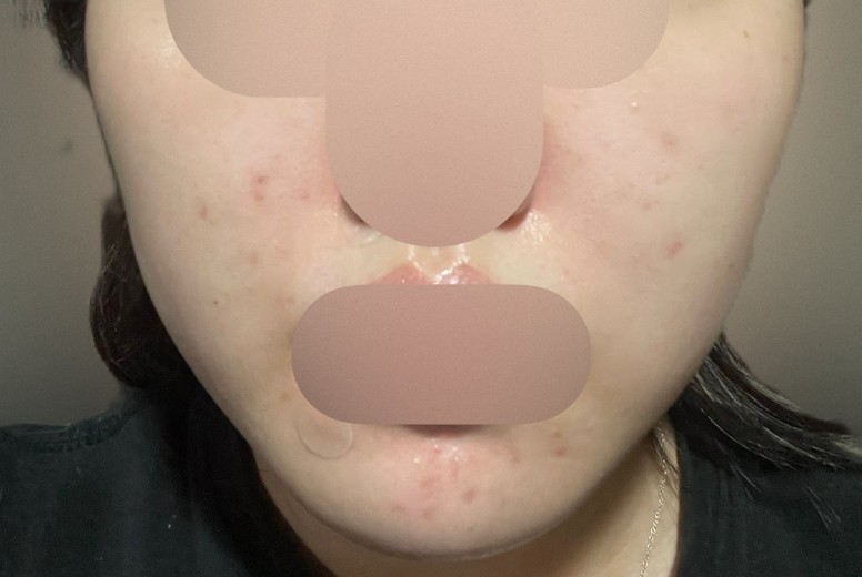 before photo: 인모드리프팅