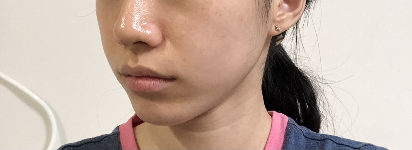 after photo: 입꼬리필러, 입술필러