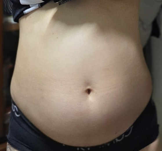 before photo: 복부지방흡입