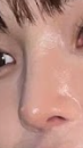 after photo: 코재수술