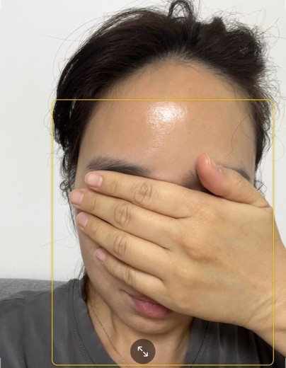 after photo: 미간보톡스, 이마주름보톡스