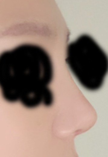 after photo: 콧대(보형물), 코끝(자가연골)