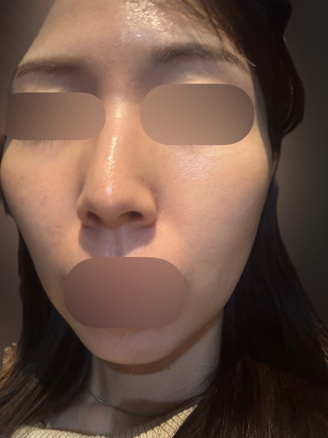 ピーリング　エレクトロポレーション エレクトロポレーション Spring | カメリア美容皮ふ科ブログ