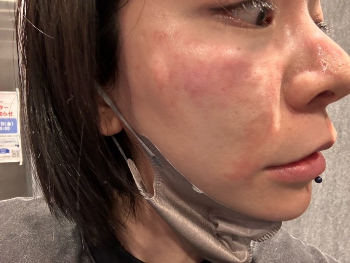 after photo: ジュベルック(Juvelook)