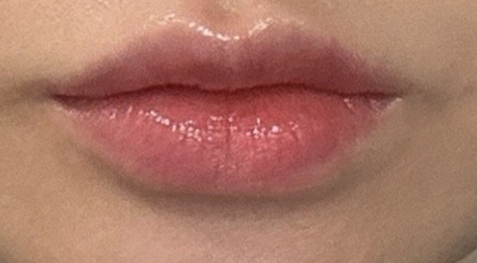 after photo: 입술필러