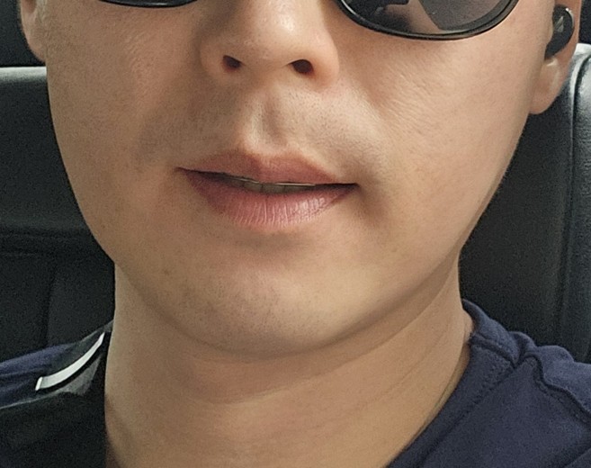 before photo: 피코토닝, 제네시스