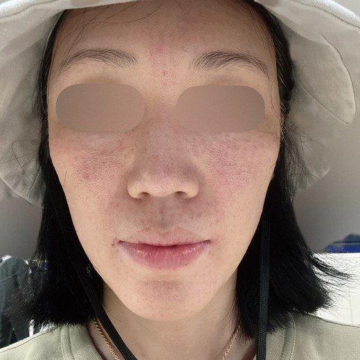 after photo: 水光注射