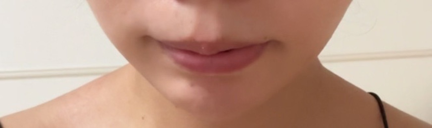 おでこにボトックスの効果と安心ポイント, image size:1743x520