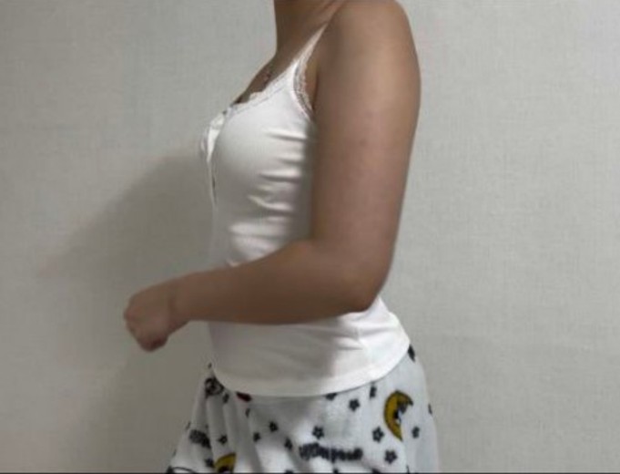 before photo: 팔지방흡입, 부유방흡입