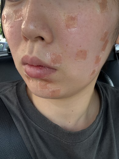 after photo: ほくろ除去(レーザー), QスイッチYAGレーザー(CuRAS Hybrid)