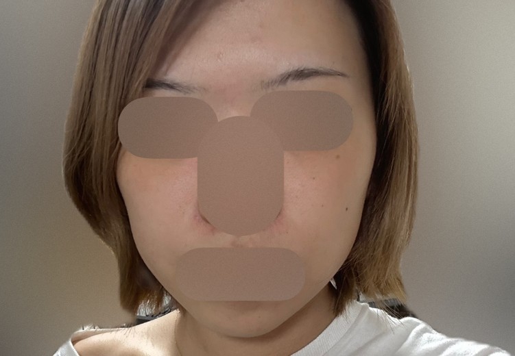 after photo: IPL(光/フォト治療)