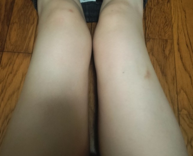 after photo: 脂肪冷却(太もも)