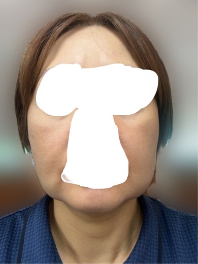 after photo: 脂肪溶解注射(顔)