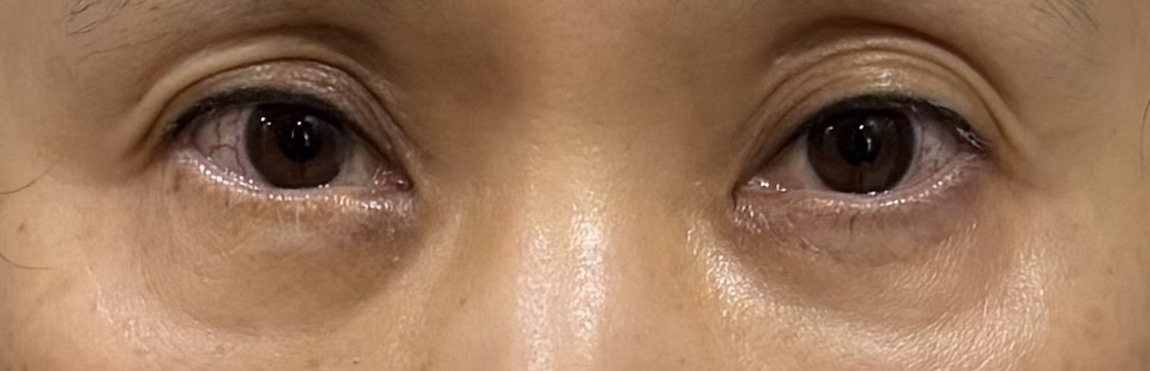 after photo: 눈밑지방재배치