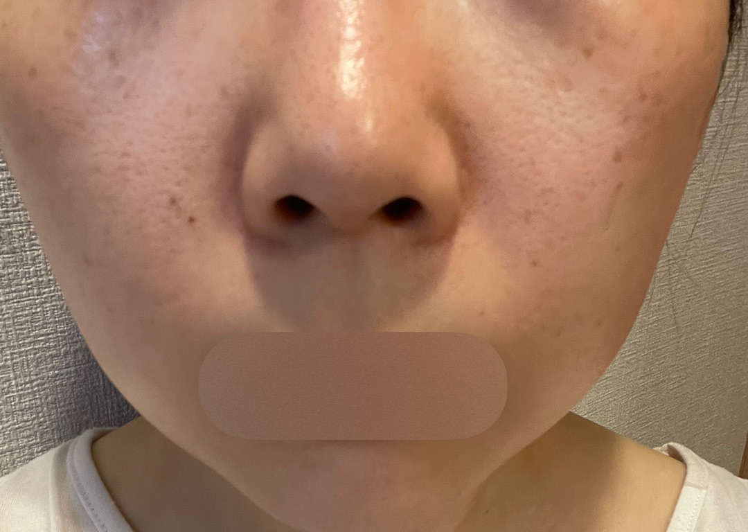 ララドクター（第5世代ピーリング）｜第5世代低刺激ピーリング