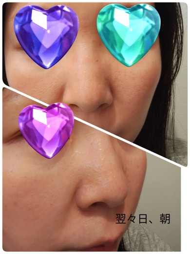 after photo: ピーリング, ダーマペン