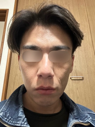 before photo: ダーマペン, エクソソーム