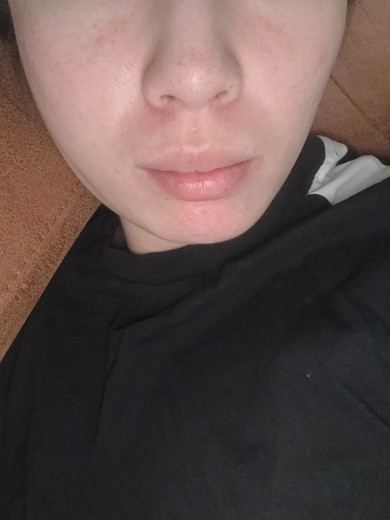 after photo: ダーマペン