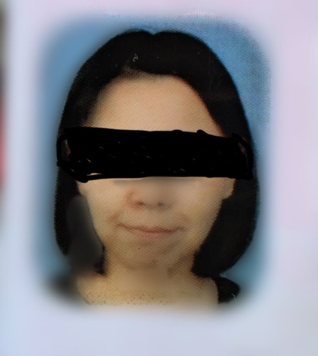 before photo: ハイフ(HIFU)
