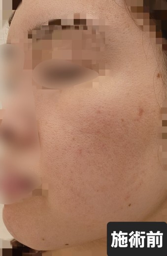 before photo: ダーマペン