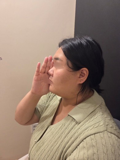 before photo: 비중격만곡증수술, 코끝(보형물)