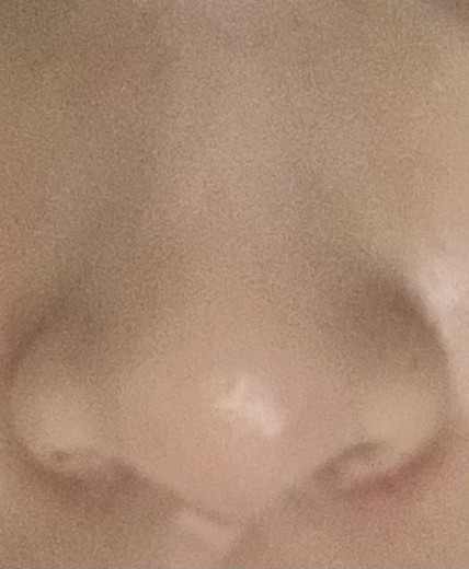 after photo: 콧볼축소