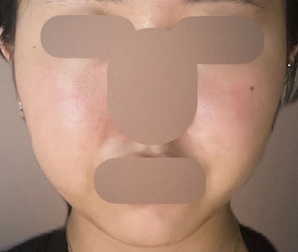 before photo: 윤곽주사, 얼굴지방분해주사