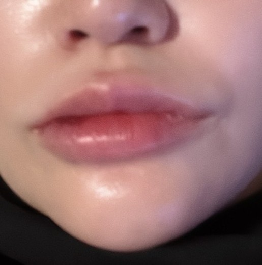 after photo: 唇ヒアルロン酸