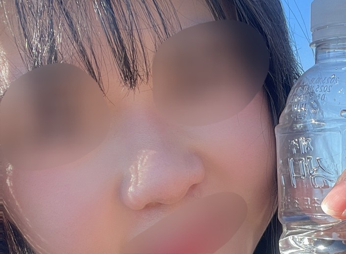 before photo: 비중격만곡증수술, 콧대(자가조직), 코끝(자가연골)