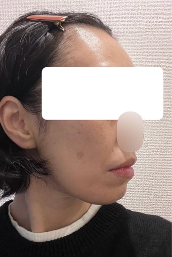 before photo: ウルトラフォーマー3(ハイフ)