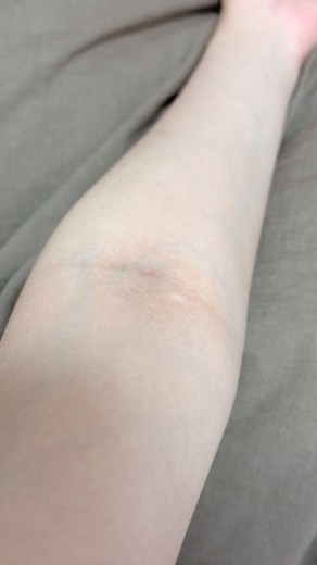 after photo: 白玉注射・点滴
