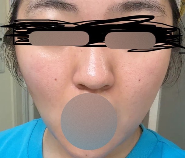 before photo: ハイドラフェイシャル