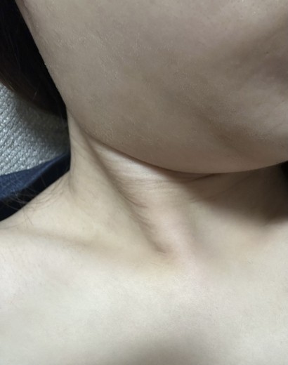 before photo: 脂肪溶解注射(顔)