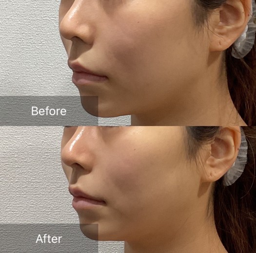 before photo: チタニウムリフト