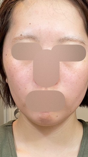 after photo: イオン導入