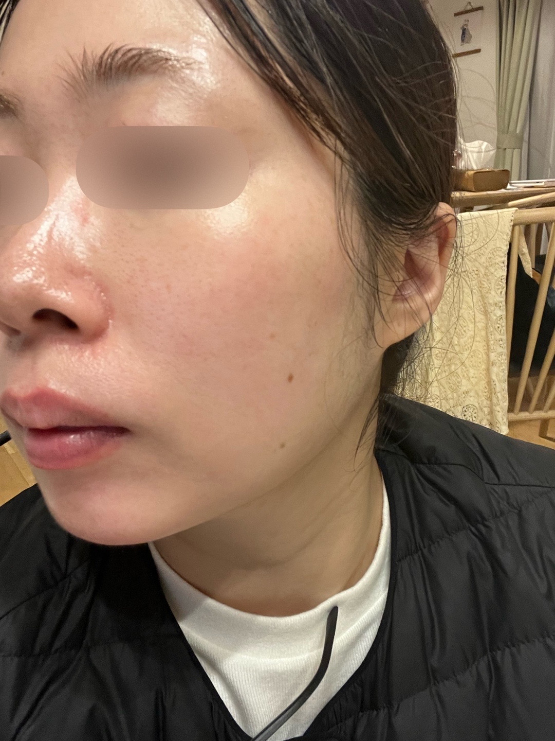 ピーリング　エレクトロポレーション 初診限定】ララピール（全顔）＋エレクトロポレーション