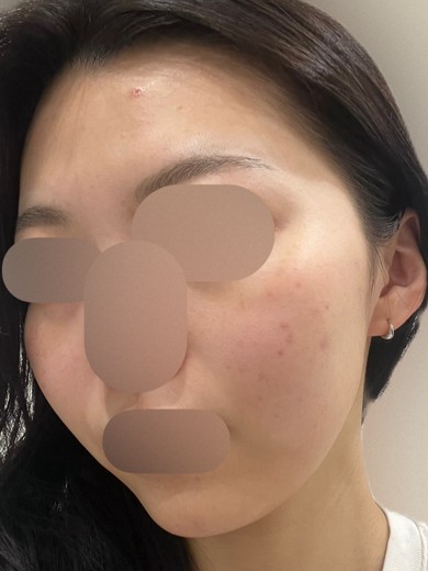 before photo: IPL(光/フォト治療)